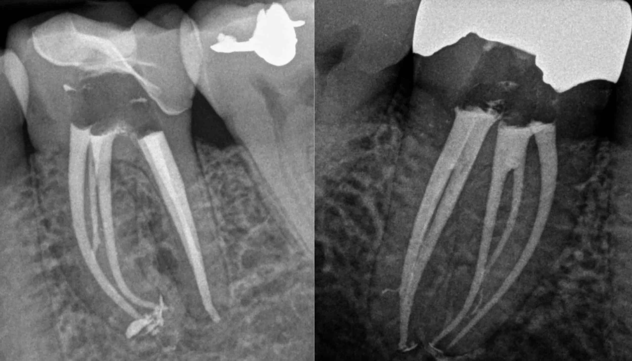 Root Canal Radiograph